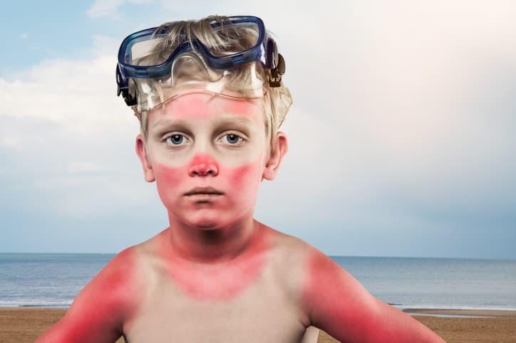 Sunburnt young boy with swimming goggles on his head